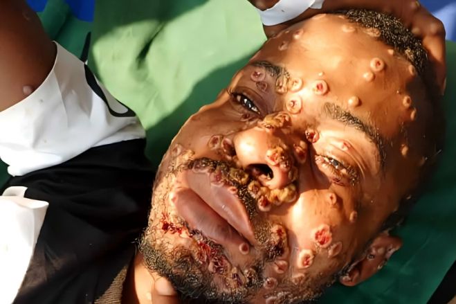 Caso suspeito do vírus Mpox notificado na província de Cabinda