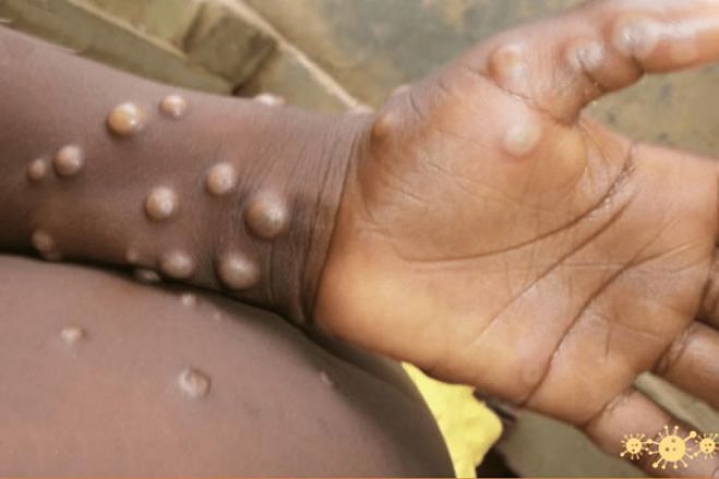 Angola reativa plano de controlo da varíola do macaco devido a surto nos Congos