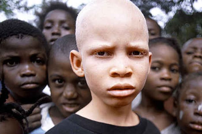 Nível de discriminação de pessoas portadoras de albinismo em Angola é alto - Estudo